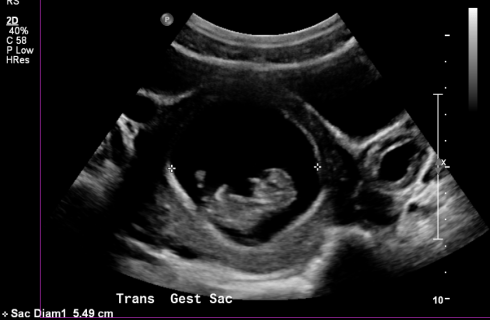 Gestational Sac