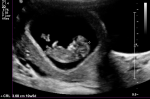 10 Week, 4 Day –&nbsp;Ultrasound