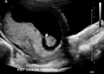 Posterior Chorion Frondosum