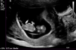 Week 10, Day 4 –&nbsp;Ultrasound