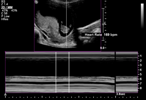 Fetal Heart Rate