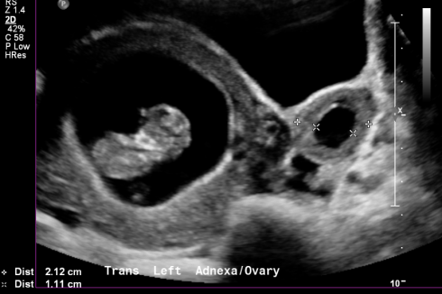 Left Ovary