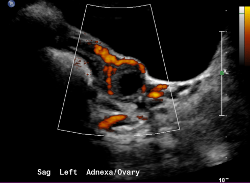 Blood Supply Left Ovary