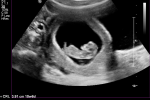Week 10, Day 4 –&nbsp;Ultrasound