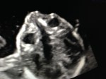 19w4d Ultrasound – Top of&nbsp;Head
