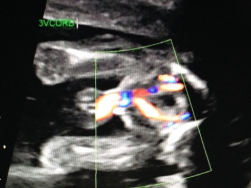 Legs and umbilical cord (showing cord blood flow)
