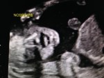 19w4d Ultrasound –&nbsp;Face