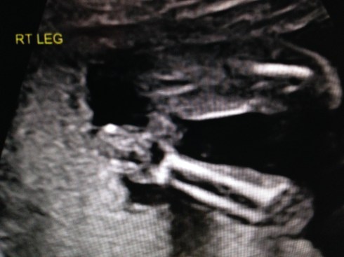 Lower leg bones (tibia/fibula)