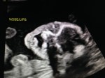 19w4d Ultrasound –&nbsp;Face