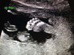 19w4d Ultrasound –&nbsp;Foot