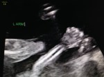 19w4d Ultrasound – Forearm & Hand