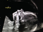 19w4d Ultrasound – Profile