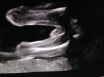 19w4d Ultrasound – Legs &&nbsp;Penis