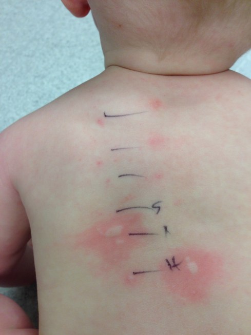 Allergy testing - May 6, 2015 