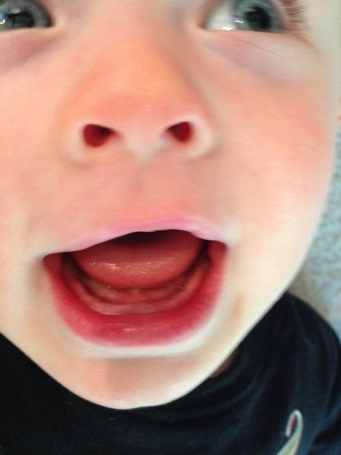Todd's first tooth is barely visible - June 15, 2015