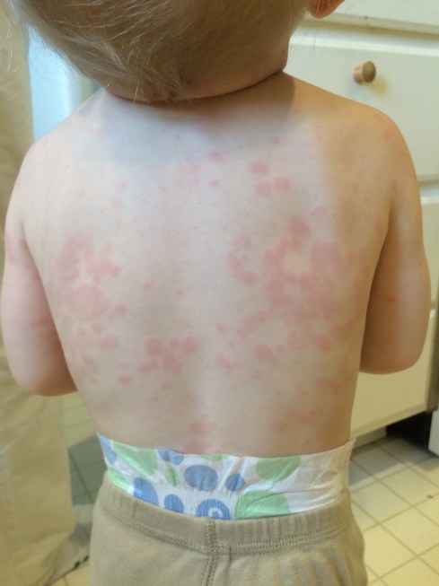 Todd's rash - April 23, 2016