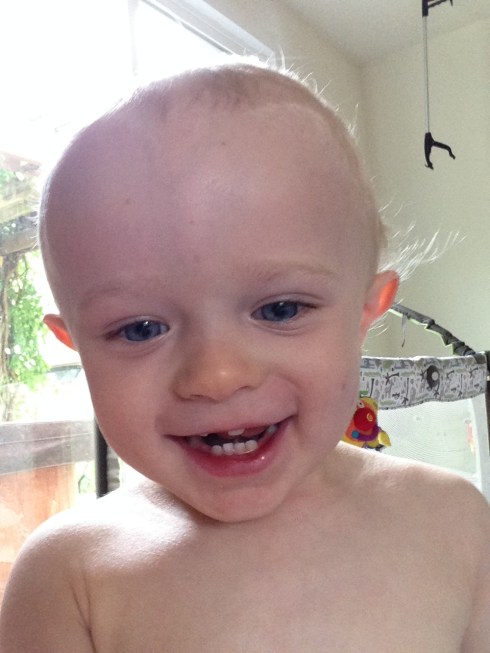 Todd's teeth - June 8, 2016